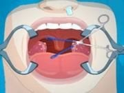 Operate now: Tonsil surgery